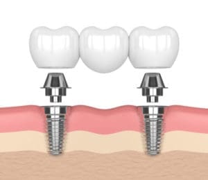 dental bridge | dental bridges Lexington MA