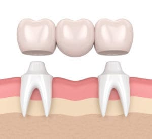 dental bridge | dental bridges Lexington MA