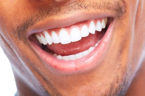 Laser Teeth Whitening Lexington MA