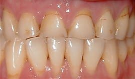 porcelain dental crowns Lexington MA