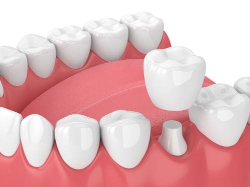 dental crowns Lexington MA | dental crown Lexington MA