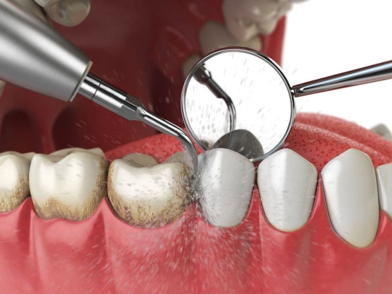 Understanding How Plaque and Tartar Damage Your Teeth