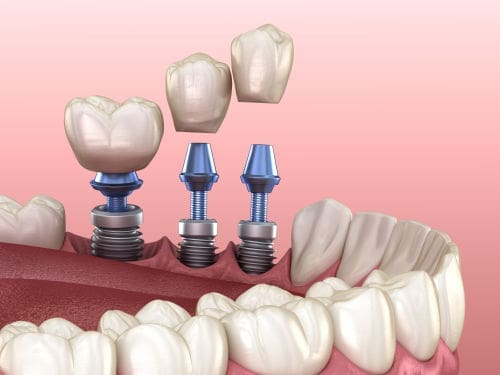 Dentist in lexington | dental implants