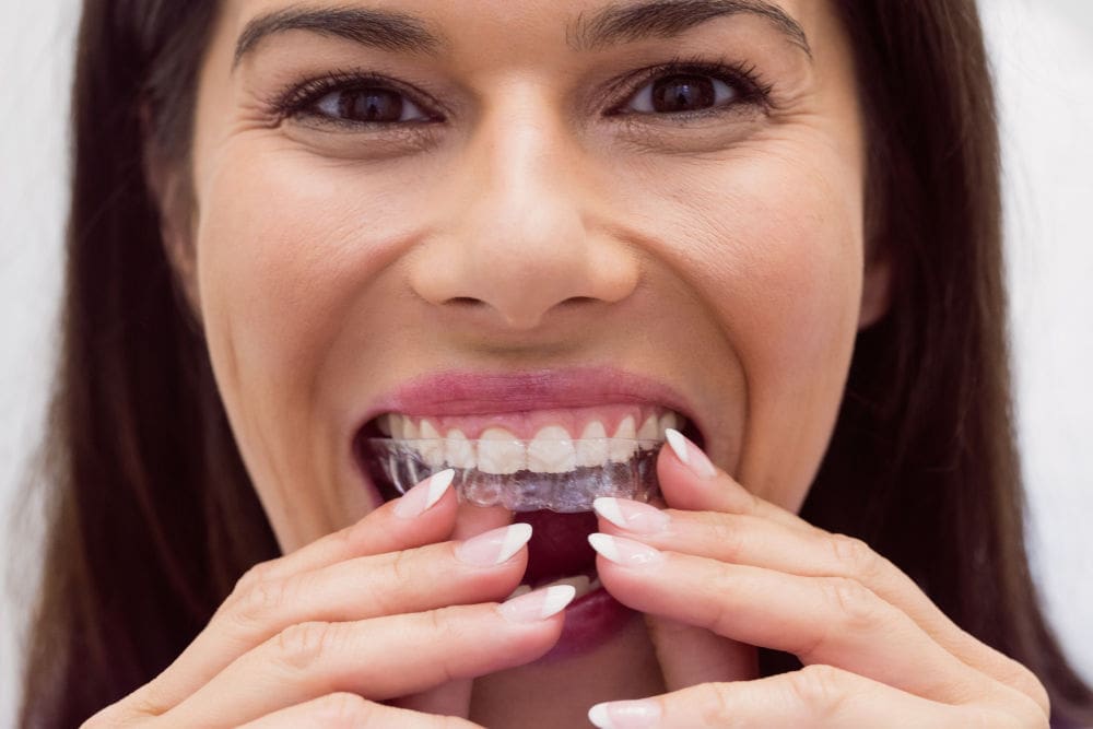 Smiling woman placing an Invisalign clear aligner over her teeth