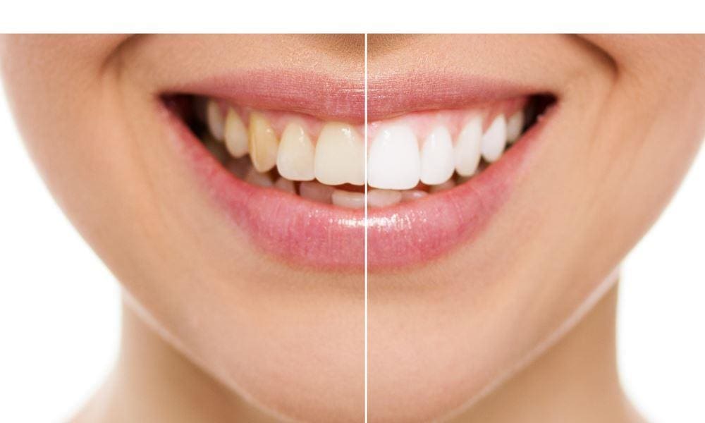 Lexington Dentists | Patient after teeth whitening procedure.