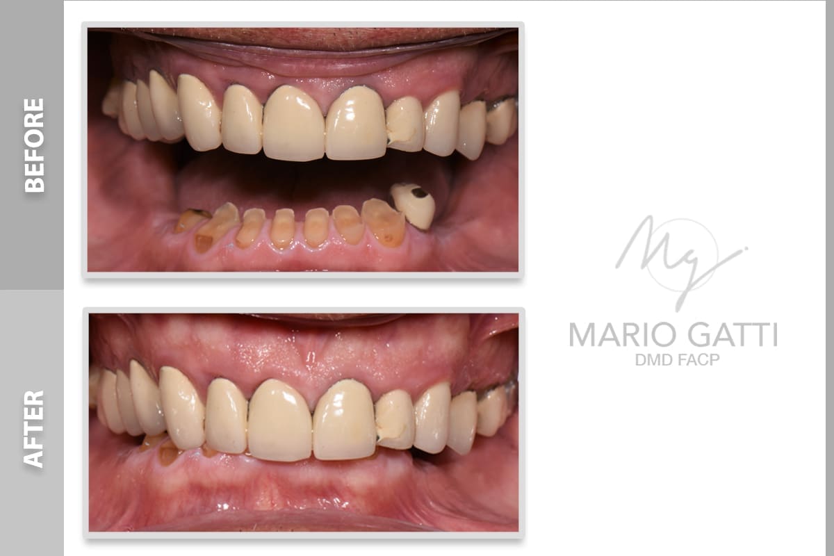 Before/After Lexington Smile Studio