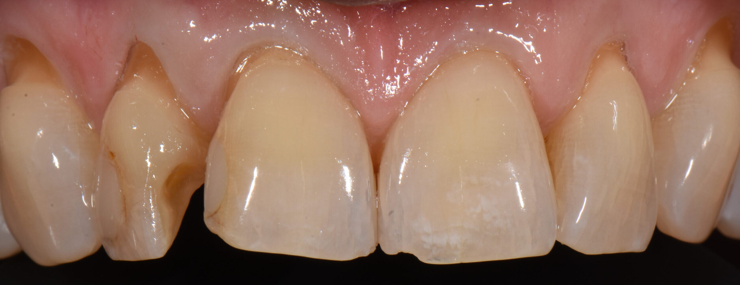 Dental Results Before and After Lexington Smile Studio