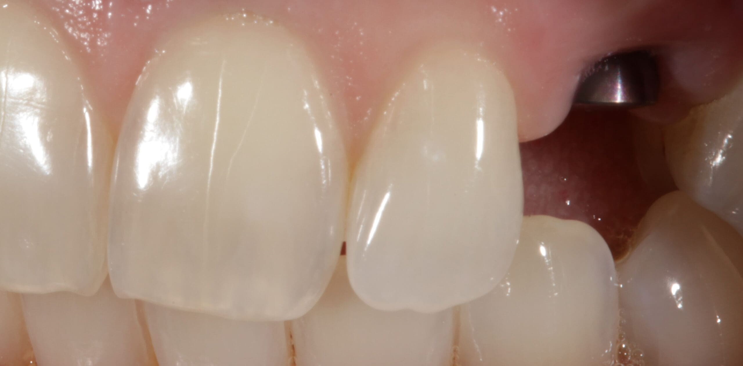 Dental Results Before and After Lexington Smile Studio