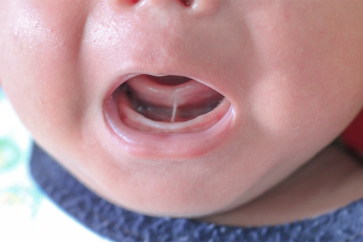 Close-up of infant’s tongue tie