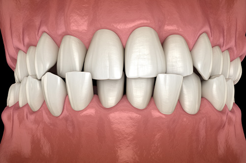 Invisalign aligners can correct crowded teeth