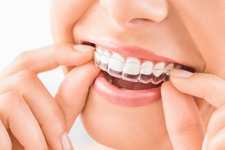 Invisalign works by gradually moving your teeth into a more ideal alignment