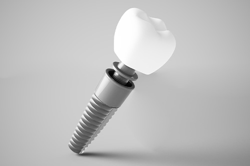 Digital image of a single dental implant.