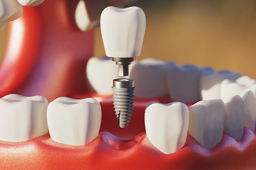 Digital image of the dental implant parts.