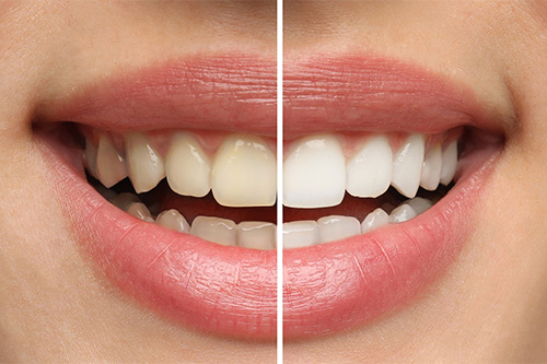 Up-close view of stained and brighter teeth.