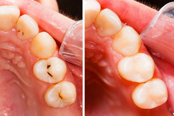 Before and after tooth-colored fillings.