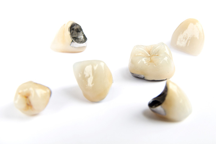 Different types of dental crowns.