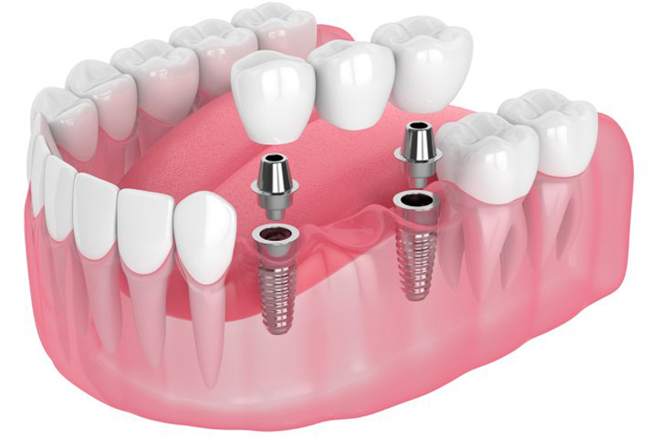 Exploded illustration of dental implants with bridge.