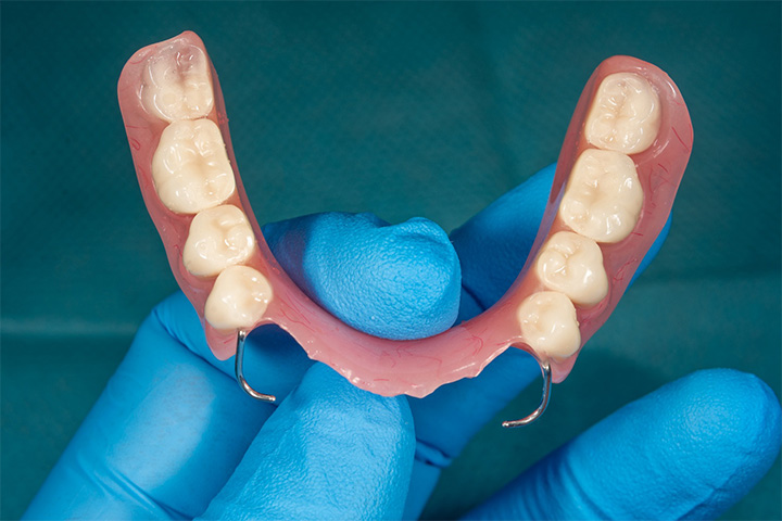 Image of a partial dentures with metal framework.