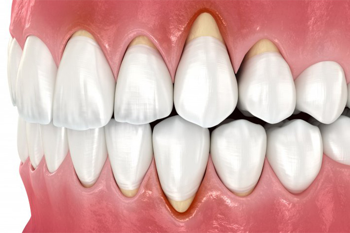 Illustration of gum recession.
