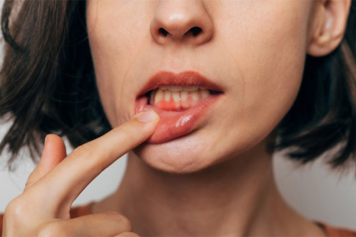 Lady shows inflamed gum tissue.